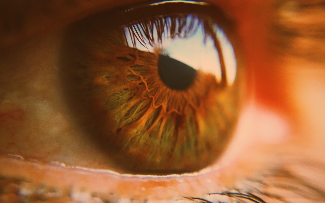 Cholesterol Signs, What Your Eyes and Skin May Be Saying