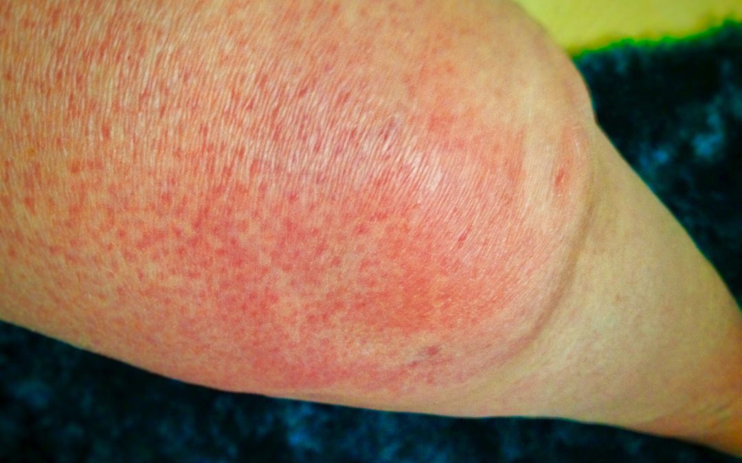 Have Swollen Legs? What To Do About It