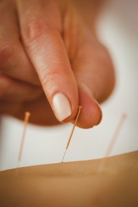 Can Acupuncture Help Your Blood Pressure?